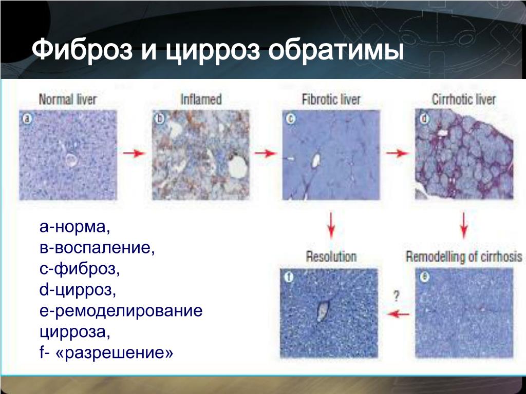 Фиброз печени что это фото