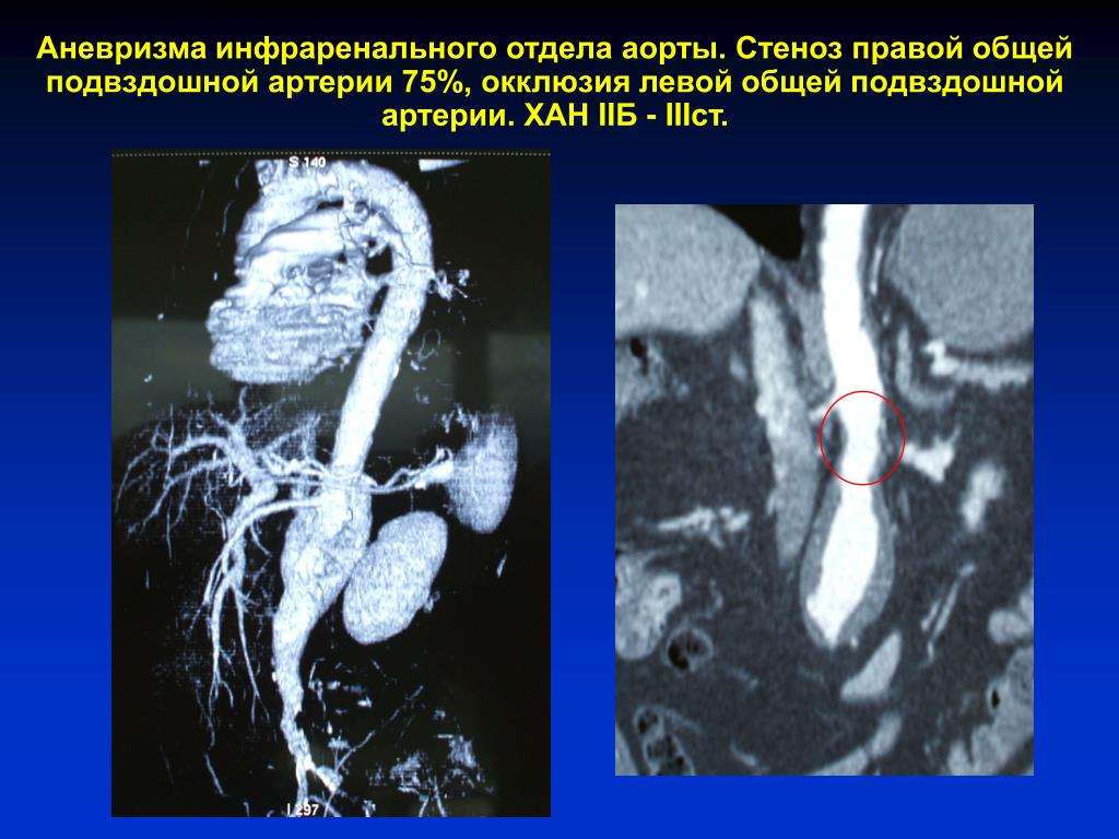 Картинки аневризмы аорты