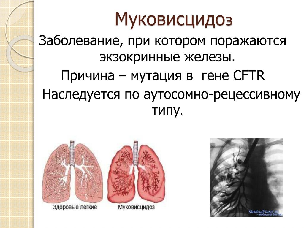 Муковисцидоз это. Генные болезни муковисцидоз. Муковисцидоз аутосомно-рецессивное заболевание. Муковисцидоз кистозный фиброз.