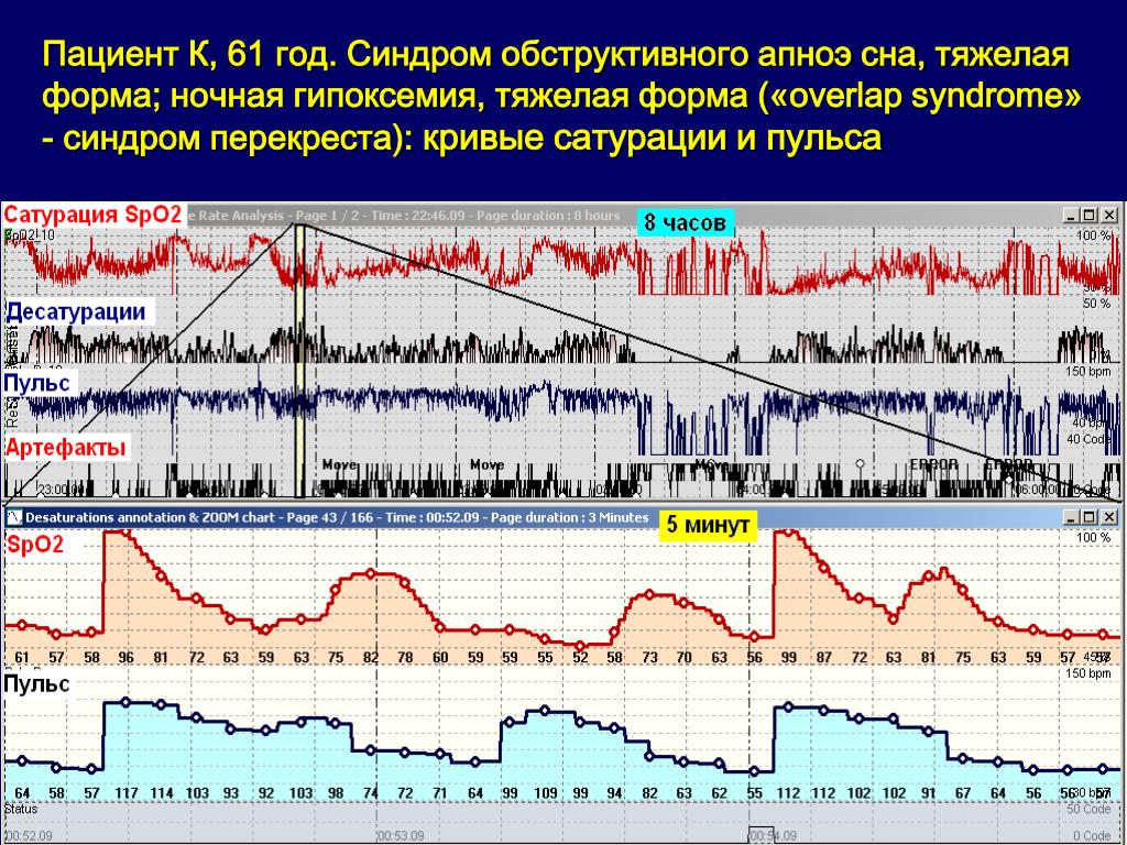 Мкб апноэ сна. Обструктивное апноэ сна. Синдром обструктивного апноэ сна.