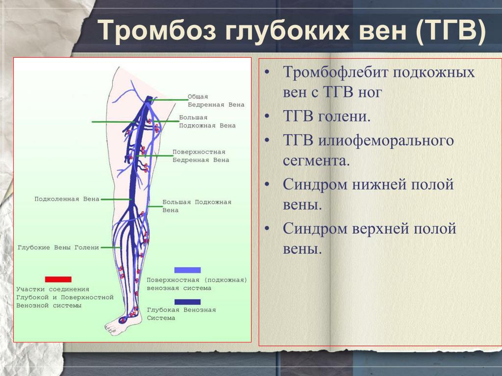 Описание тромба. Флеботромбоз поверхностных вен нижних конечностей. Тромбоз вены нижней конечности. Острый тромбофлебит большой подкожной вены. Сегменты сосудов нижних конечностей.