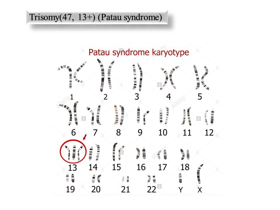 Трисомия это