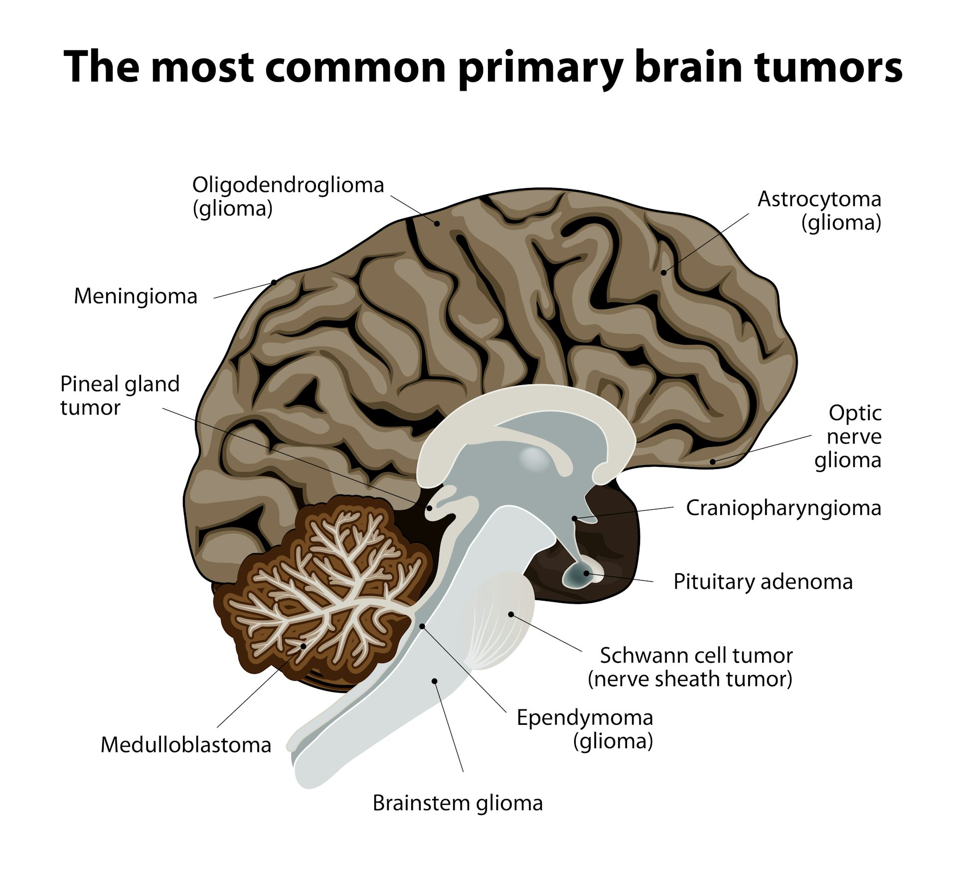 Виды опухолей головного. Локализация опухолей головного мозга. Виды вторичных опухолей головного мозга. Первичные симптомы опухолей головного мозга. Объемное образование мозга.