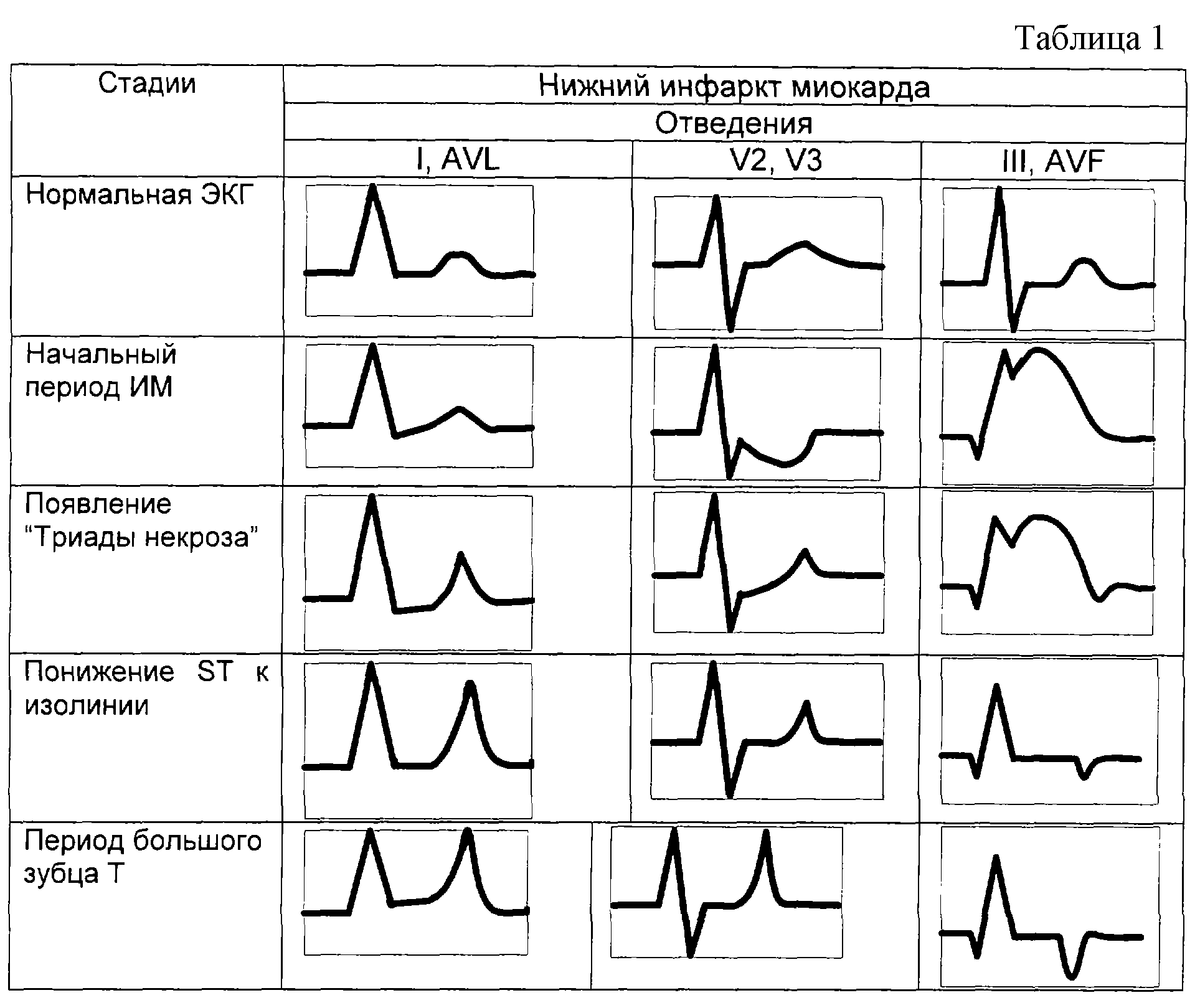 Экг степень. Острый Нижний инфаркт миокарда на ЭКГ. Инфаркт миокарда ЭКГ шпаргалка. Инфаркт миокарда ЭКГ таблица. Отведения ЭКГ при инфаркте миокарда.