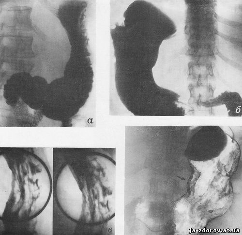 Рентгеноскопия желудка фото