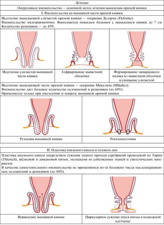 Лечение выпадения прямой кишки у взрослого. Выпадение прямой кишки классификация. Операции выполняемые при выпадении прямой кишки. Операции при выпадении прямой кишки слизистой оболочки. Ректальный пролапс классификация.
