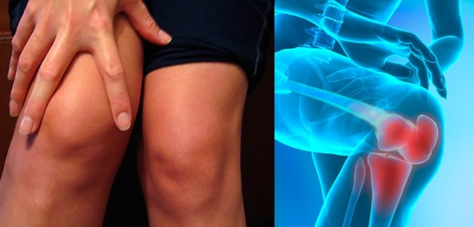 Артроз коленного сустава название. Пателлофеморальный артроз коленного. Что такое липартрит коленного сустава. Гонартроз гонартроз коксартроз. Симптомы гонартроза коленного сустава.