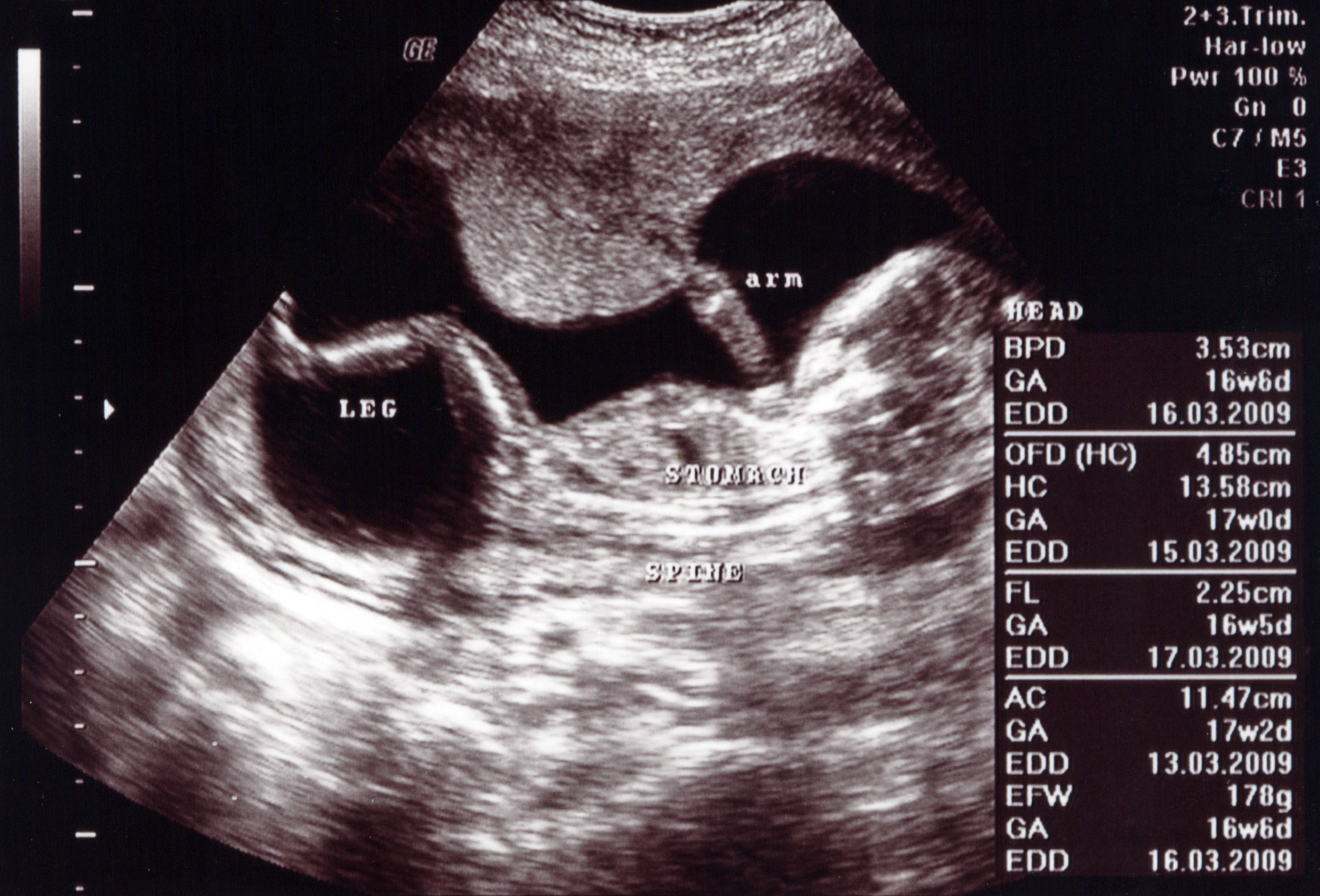 УЗИ на 16-17 неделе беременности