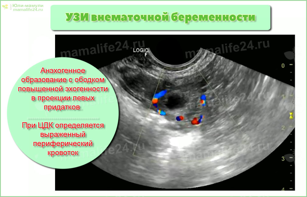 Внематочная беременность симптомы на ранних сроках фото