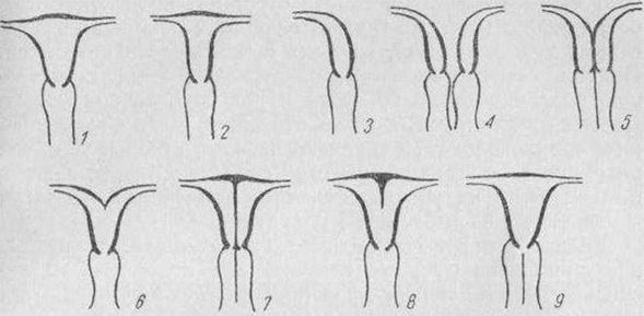 Аномалии Влагалища Фото
