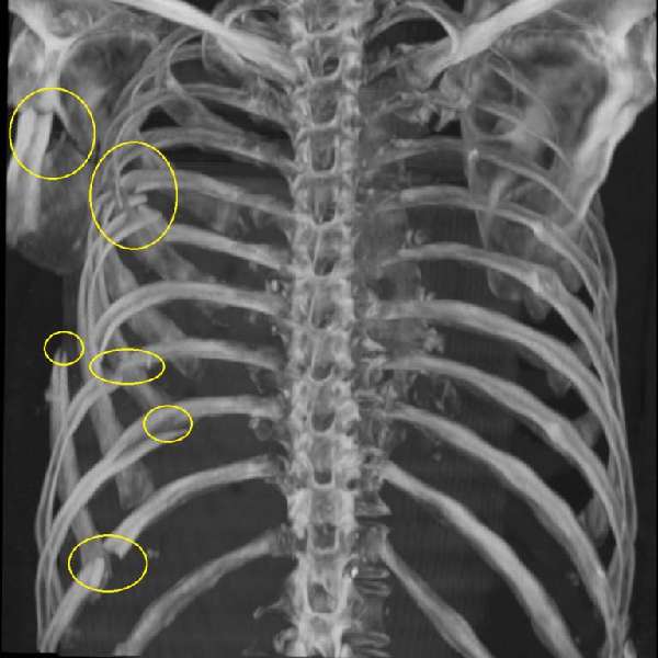 переломы на рентгене грудной клетки