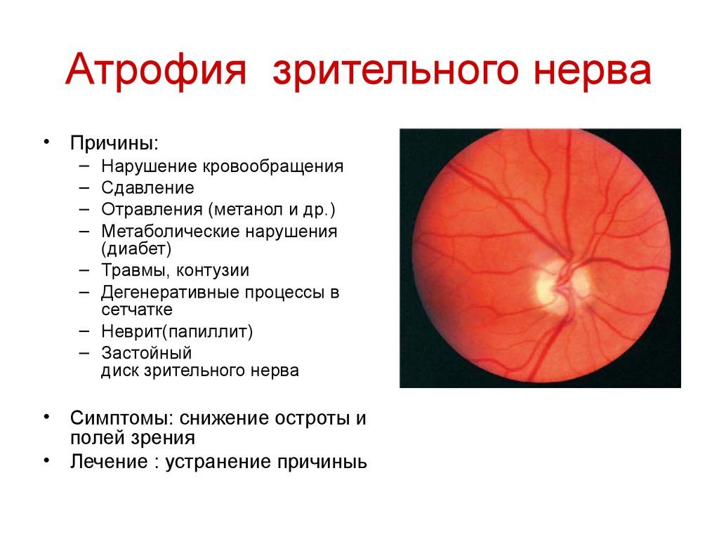 В каких странах и как лечат атрофию зрительного нерва?