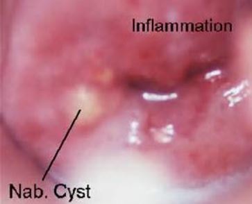 nabothian cyst image