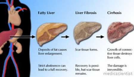 Chronic Hepatitis