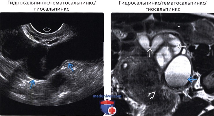 Гидросальпинкс узи картина