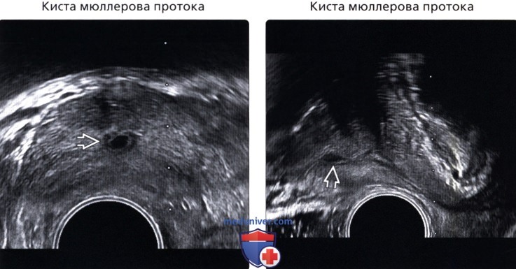 Киста у мужчин. Киста Мюллерова протока эхограмма. Кисты предстательной железы эхограммы. Киста маточки простаты. Киста Мюллерова протока предстательной железы мрт.