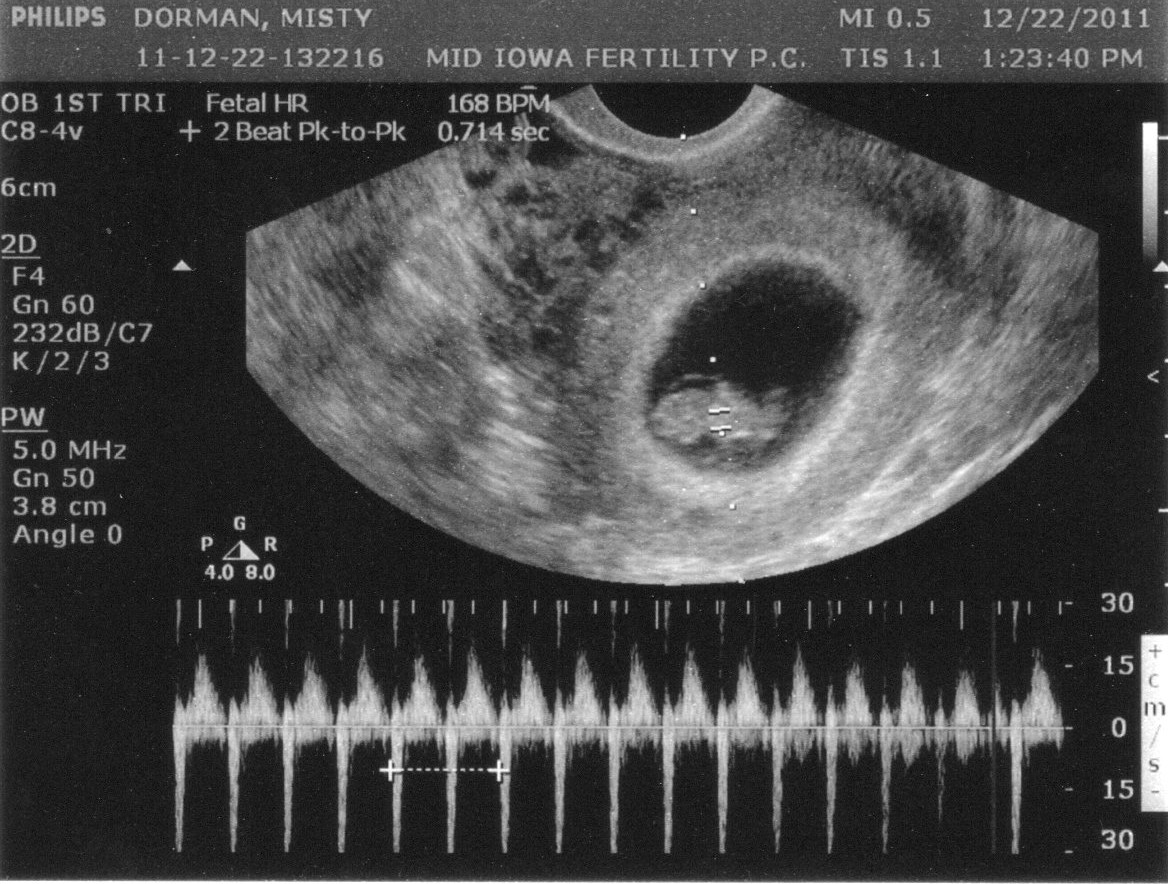 9 недель беременности размер плода. Размер плода на 8 неделе беременности. Размер эмбриона на 9 неделе. Размер эмбриона на 8 неделе.