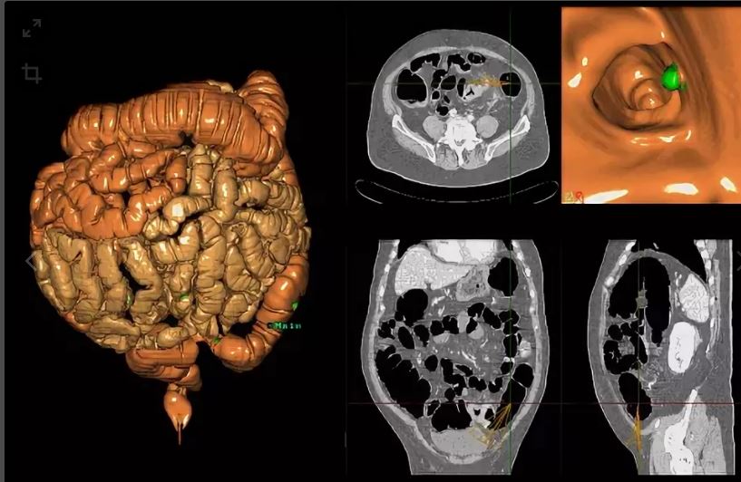 Можно ли сделать мрт кишечника. Мрт брюшной полости толстой кишки. Мрт Толстого кишечника. Мрт тонкого и Толстого кишечника. Кт кишечника кишечная непроходимость.