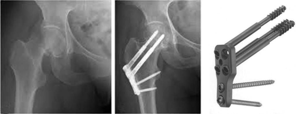 Тазобедренный перелом операция. Перелом плечевой кости экстрамедуллярный остеосинтез. Интрамедуллярный остеосинтез шейки бедра гамма. Остеосинтез тазобедренного сустава рентген.