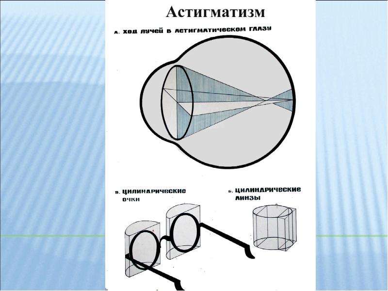 Коррекция астигматизма. Цилиндрическая линза астигматизм. Астигматизм схема. Астигматические линзы цилиндр. Цилиндрические линзы при астигматизме.