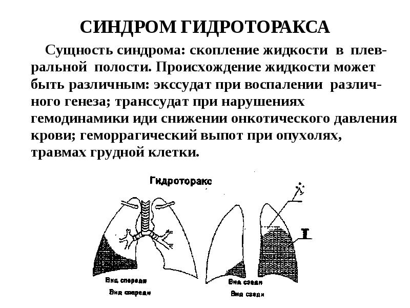 Гидроторакс легких карта вызова