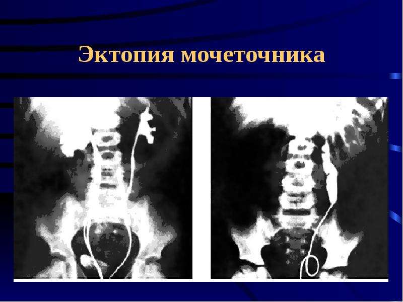 Расположение мочевого пузыря и матки фото