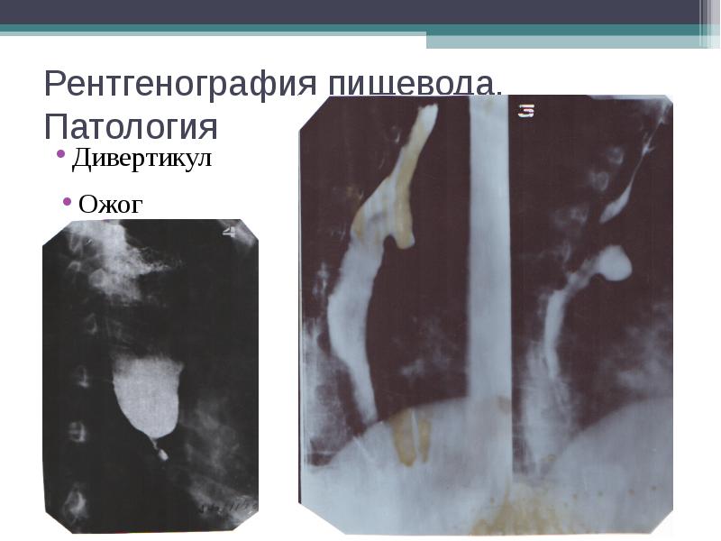 Рентген пищевода. Лейомиома пищевода рентген. Дивертикул пищевода рентген. Рентгенография дивертикула пищевода протокол. Полип пищевода рентген.