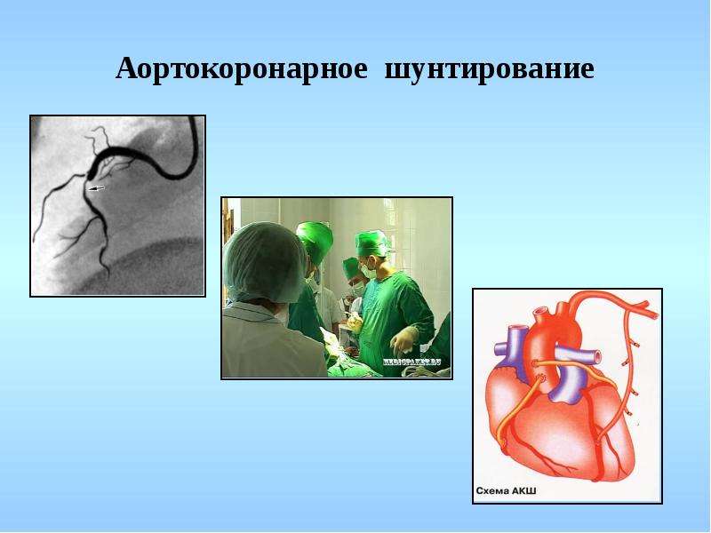 Аортокоронарное шунтирование схема операции