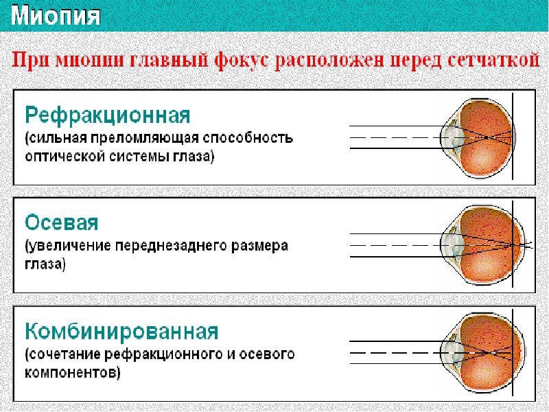 Миопия средней степени группа здоровья