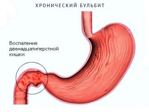 кишечника, с нестабильностью стула с запорами и диареей. Данный воспалительный процесс в двенадцатиперстной кишке может быть результатом хронического гастрита и дуоденита. В качестве самостоятельного заболевания дуоденит наблюдается крайне редко. Изменения в состоянии кишечника