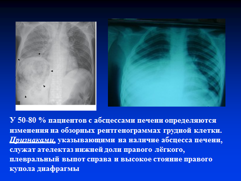 Стояние купола диафрагмы. Высокое стояние левого купола диафрагмы. Высокое стояние правого купола диафрагмы. Высокое стояние диафрагмы справа. Высота стояния правого купола диафрагмы.