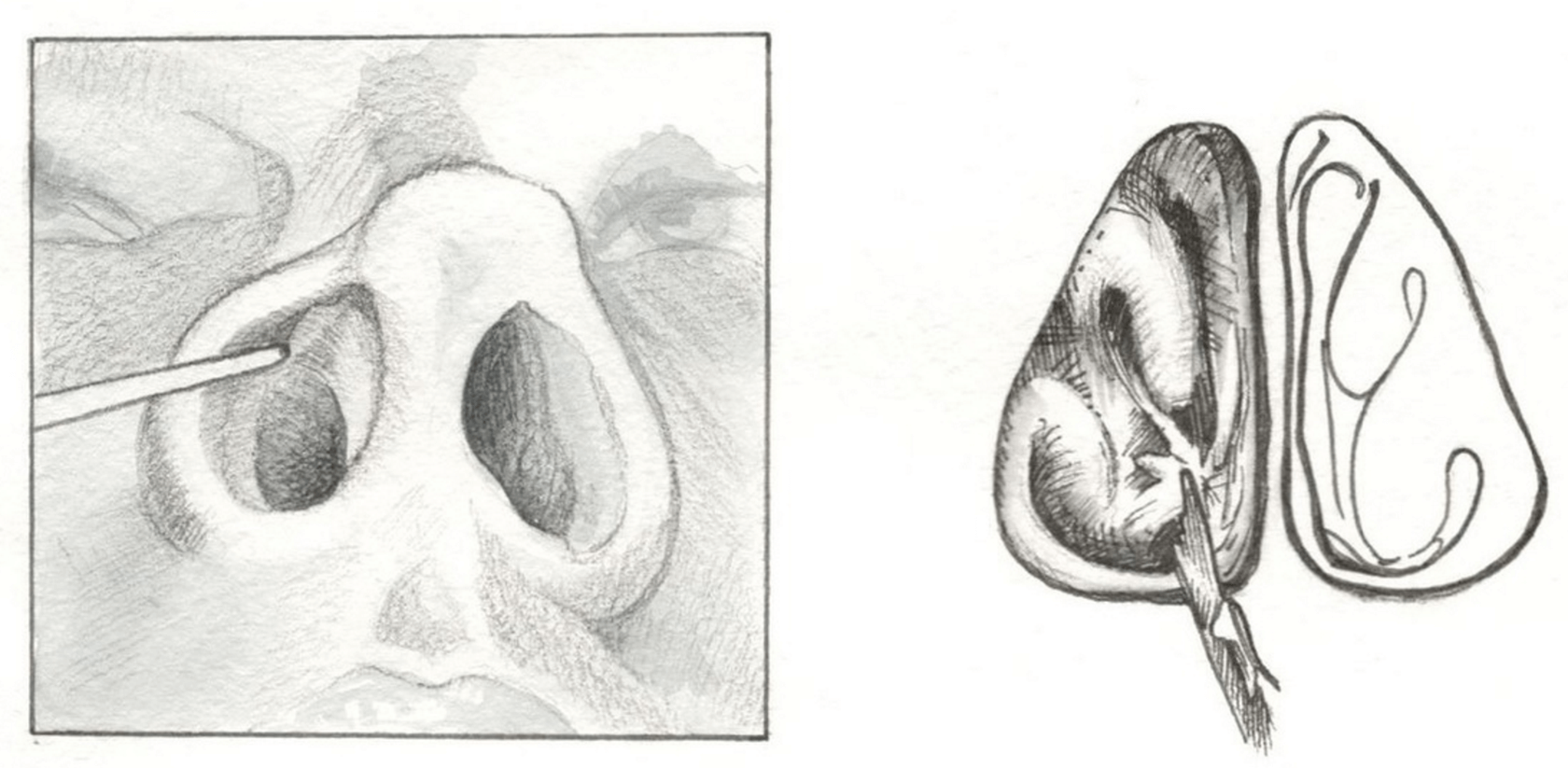 Персик форма половых губ у девушек. Синехии носовой перегородки. Синехии носовых раковин. Иссечение синехии в полости носа.