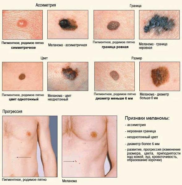 Отличие родинок от меланомы