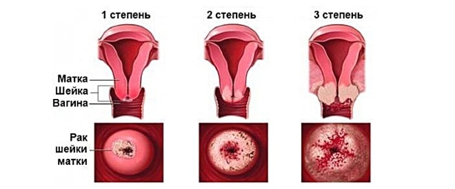 Первые симптомы рака: как распознать онкологию на ранних стадиях