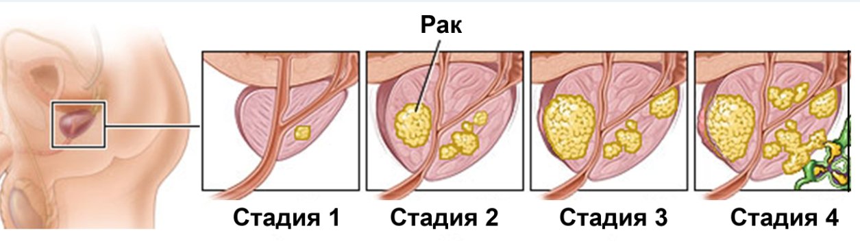 Первые симптомы рака: как распознать онкологию на ранних стадиях