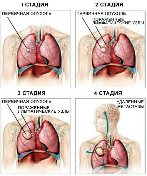 Первые симптомы рака: как распознать онкологию на ранних стадиях