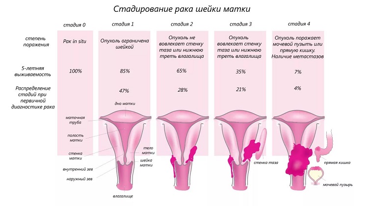 Рак матки: первые признаки и симптомы, диагностика, лечение, выживаемость