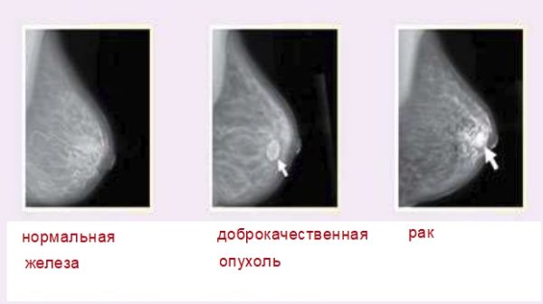 Аденома молочной железы и отличие от рака