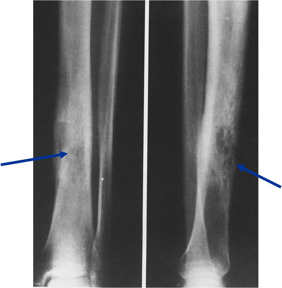 Костные саркомы. Саркома Юинга большеберцовой кости рентген. Остеомиелит большеберцовой кости. Остеосаркома большеберцовой кости рентген. Саркома большеберцовой кости рентген.