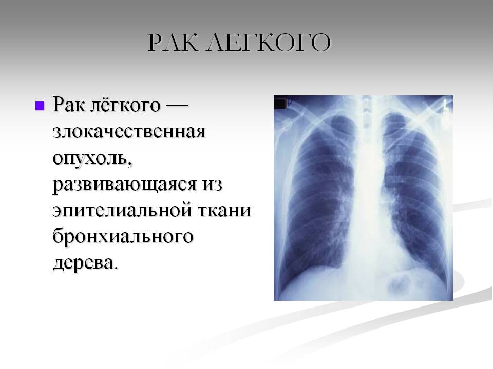 Рак легкого презентация по онкологии