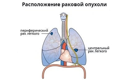 Размещение опухоли