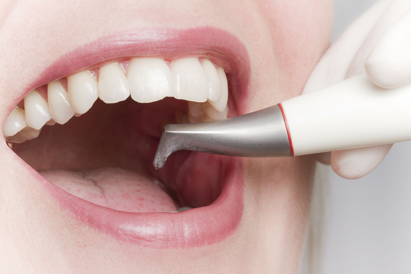отбеливание зубов с пришеечным кариесом