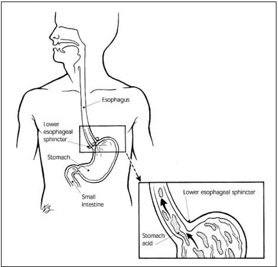 Заброс из пищевода в горло. Сфинктеры пищеварительной системы. Клапан желудка и пищевода сфинктер. Пищеводно желудочный сфинктер. Нижний пищеводный сфинктер.