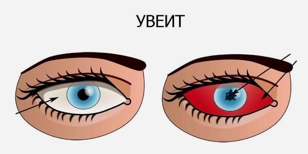 Увеит