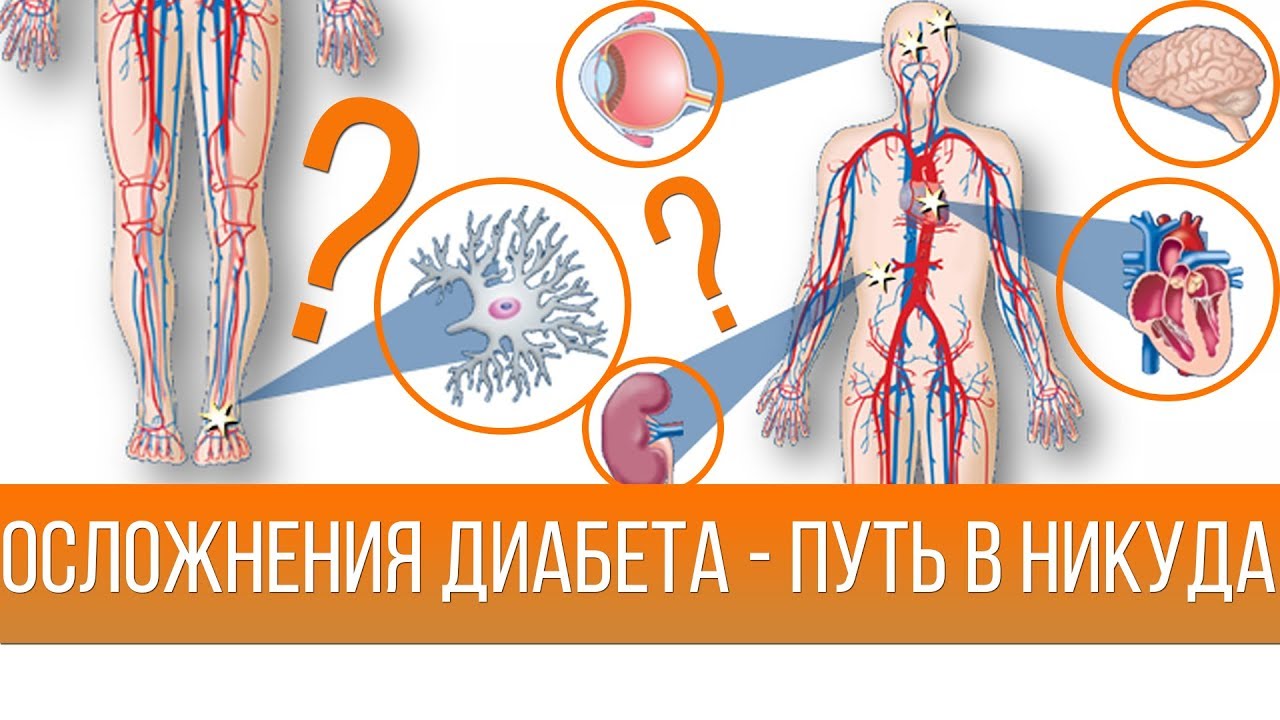 Осложнения сахарного диабета картинки для презентации