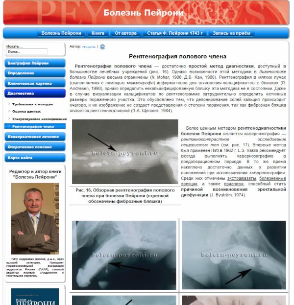 Болезнь пейрони. Болезнь Пейрони рентген. Фиброзная бляшка Пейрони.