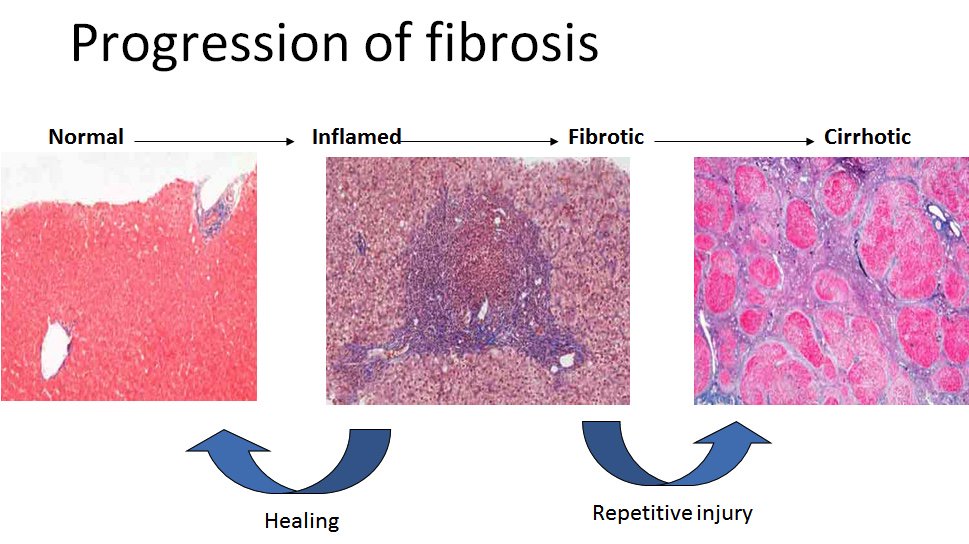 Что такое фиброз. Фиброз печени гистология. Кистозный фиброз печени. Фиброз печени 4 степени.