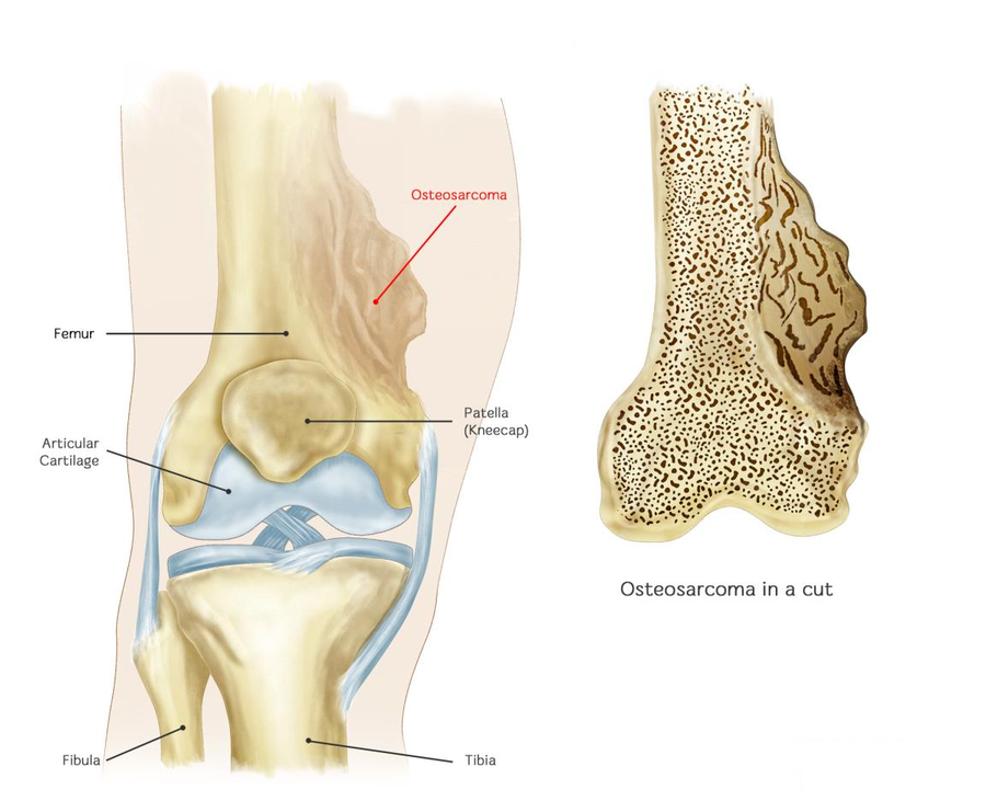 Остеосаркома сустав. Остеосаркома и остеохондрома. Остеосаркома бедренной кости макропрепарат. Остеохондрома малоберцовой кости. Остеохондрома бедренной кости.