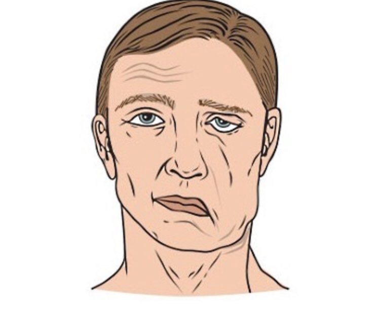 Лицевой нерв удаление. Инсульт парез лицевого нерва. Неврит лицевого нерва слева. Периферический неврит лицевого нерва.