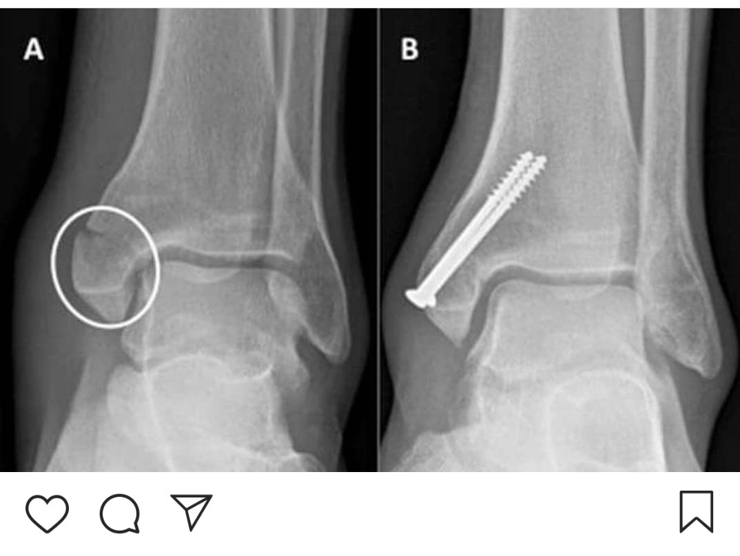 Перелом лодыжки без смещения фото рентгена